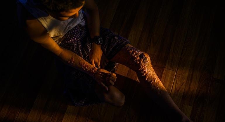 Children and Amputees Most Affected by Myanmar’s Deadly Landmine Crisis