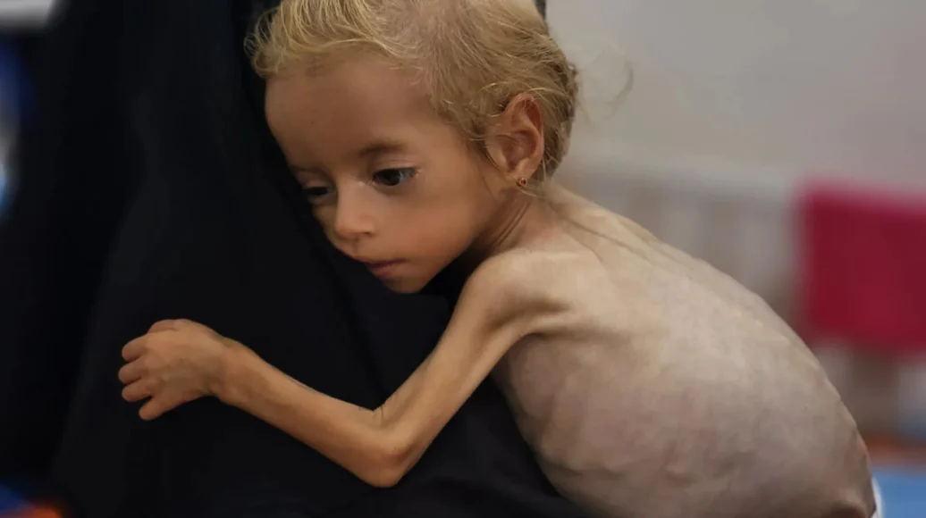 100 Children Die of Malnutrition, Reports Gaza Health Ministry