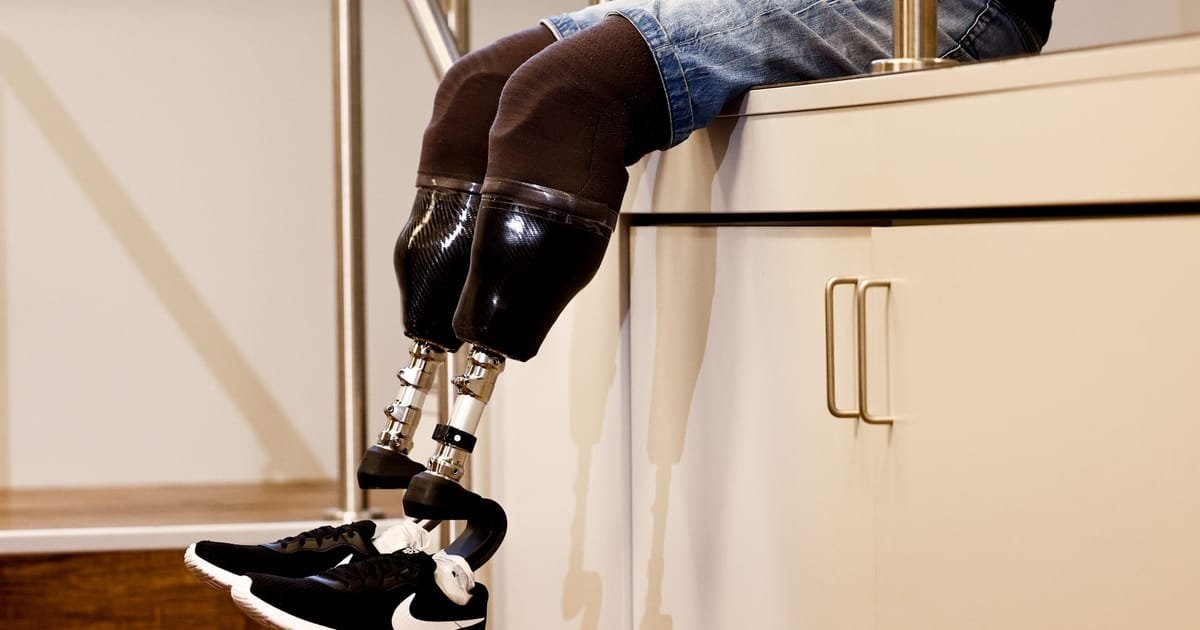Kremlin Official Praises Ukraine War for Advancing Prosthetics Development